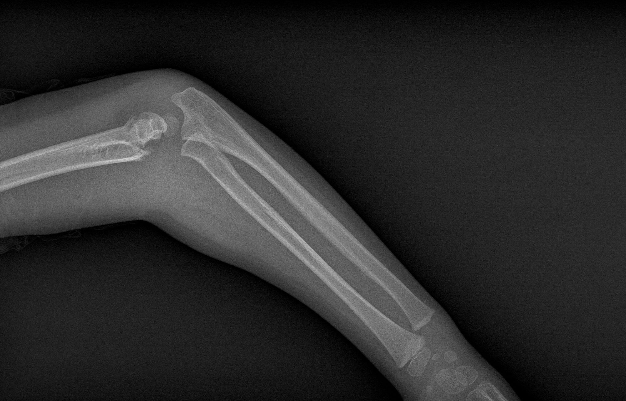 Different Types Of Fractures