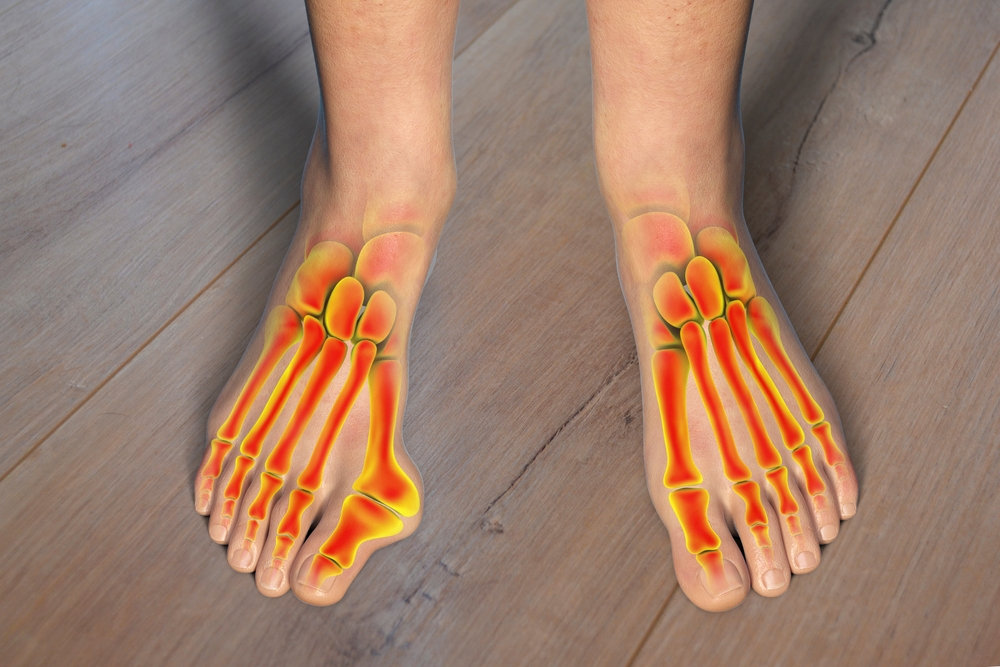 natural bunion treatment